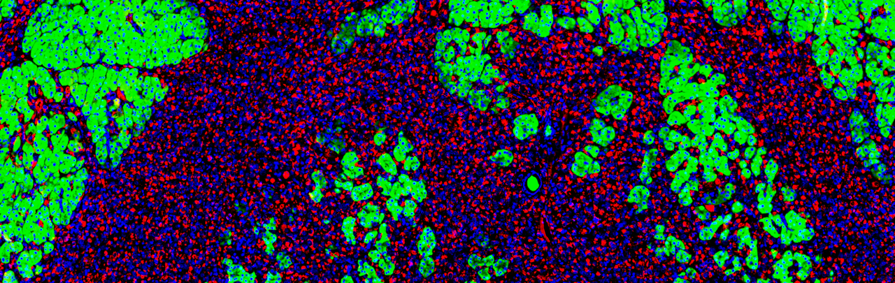 TiME is of the essence: Tumor-instructed immune intrusion shapes pancreatic cancer subtype identity