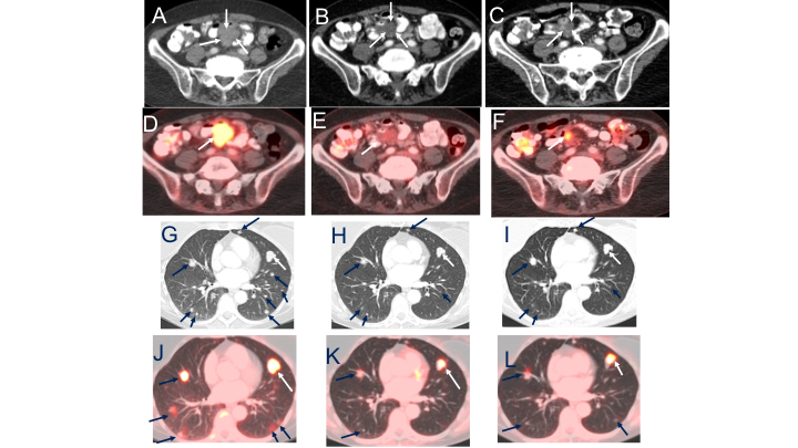 A tale of Precision Medicine and the importance of repeat genomic testing 
