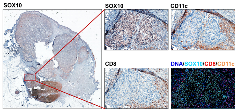 Mechanism of acquired resistance to BRAF/MEK-targeted therapies in metastatic melanoma: Location, Location, Location?