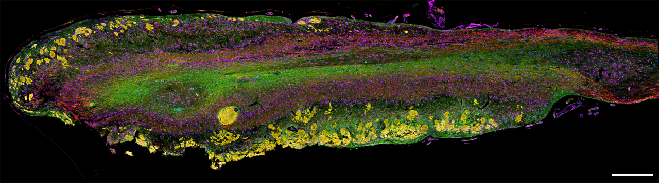 Painting the brain: multiplex immunohistochemistry of the human olfactory bulb in normal ageing and disease