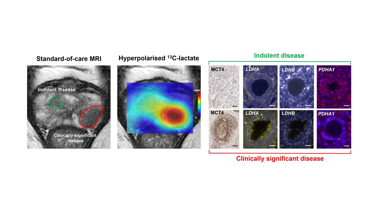 Hyperpolarised 13C-MRI identifies the emergence of a glycolytic cell population within intermediate-risk human prostate cancer