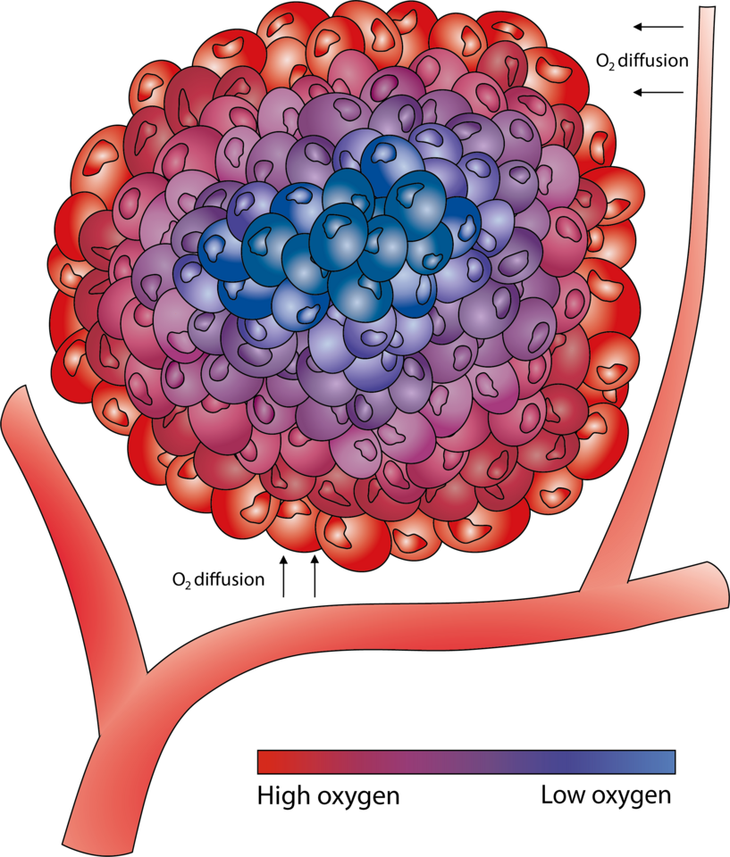 How does intra-tumour low oxygen levels relate to the clinical outcome after radiotherapy in breast cancer? 