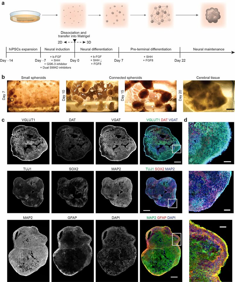In-vitro engineered human cerebral tissues mimic pathological circuit disturbances in 3D