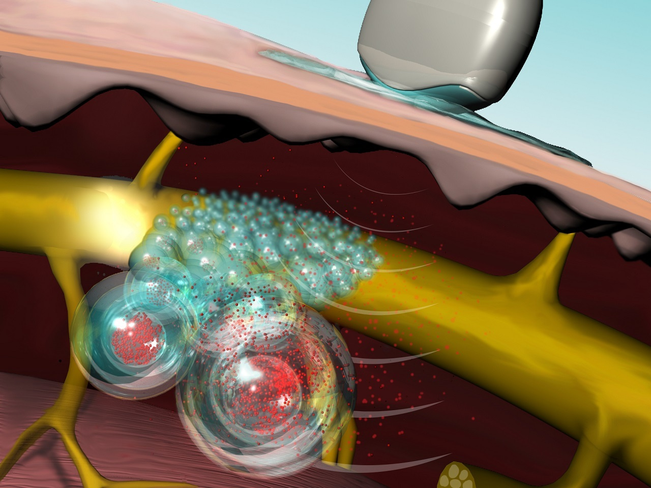 Ultrasound-triggerable local anaesthesia