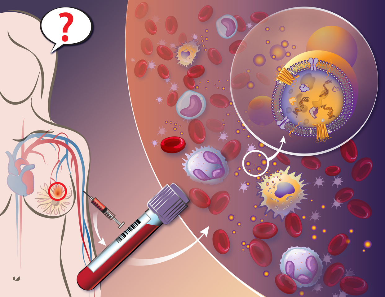 Hiding in Plain Sight: Early, nano-sized signs of breast cancer detected by liquid biopsy