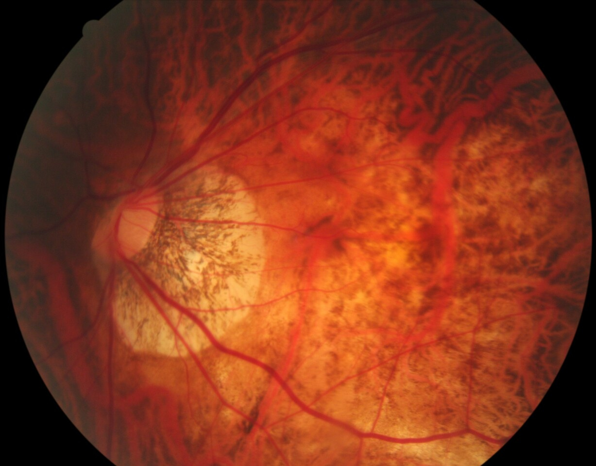 Deep Learning System to Predict the 5-year Risk of High Myopia using Fundus Imaging in Children