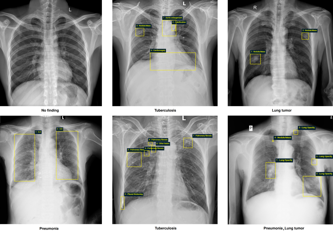 VinDr-CXR:  The largest public chest X-ray  dataset with radiologist-generated annotations for machine learning-based computer-aided diagnosis (CAD)  