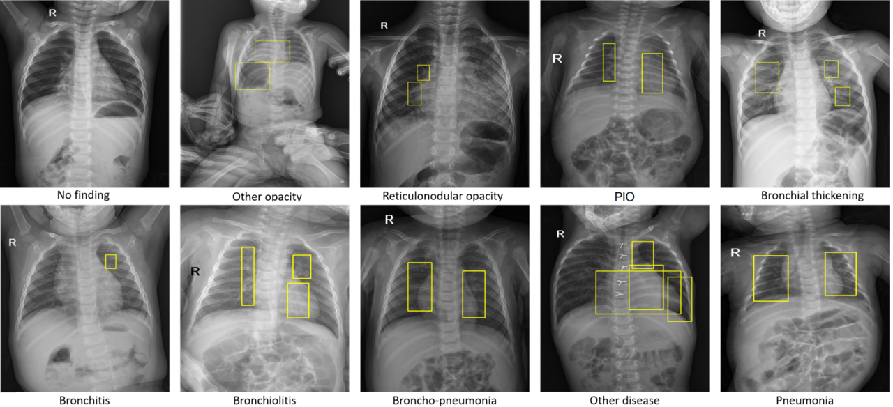 PediCXR: Advancing the interpretation of common thoracic diseases in children