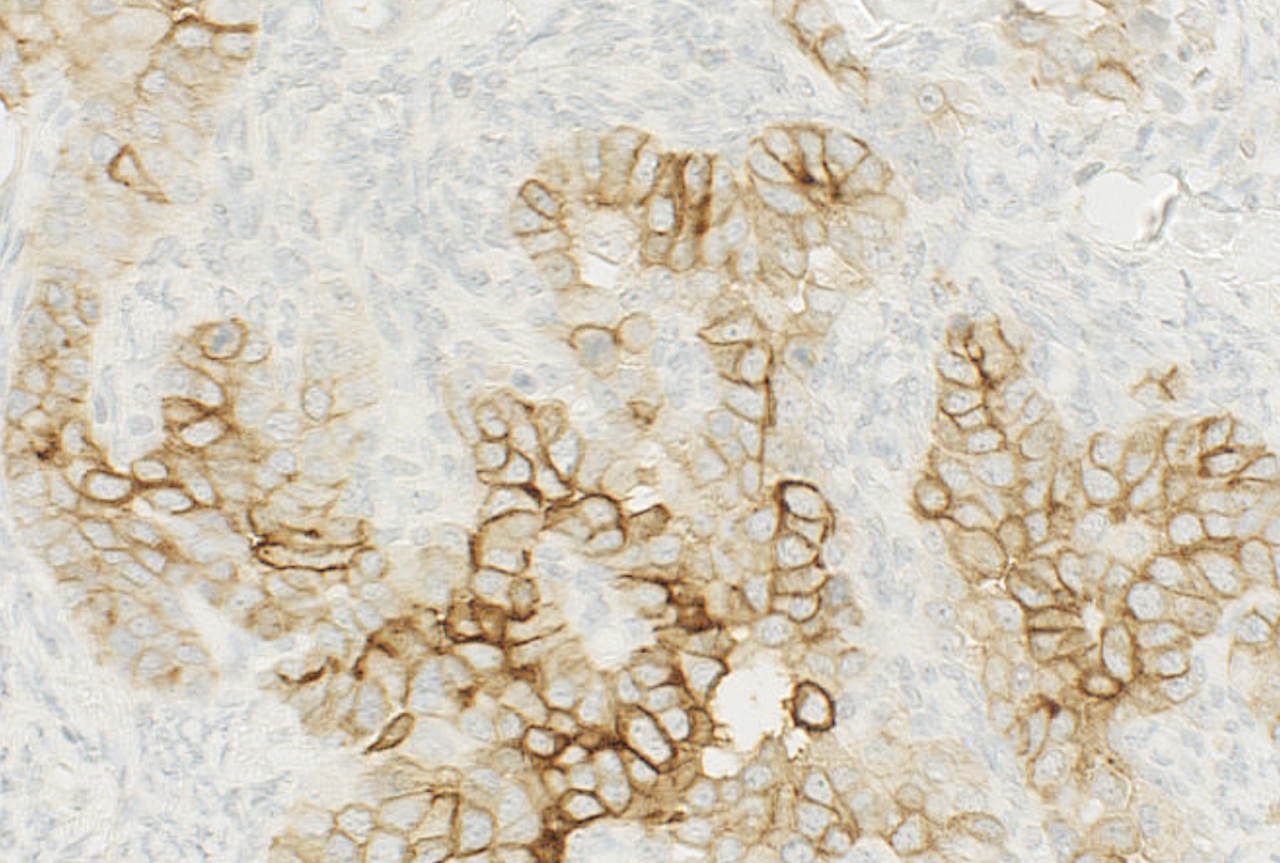 Novel therapy for cancer using an IgE antibody