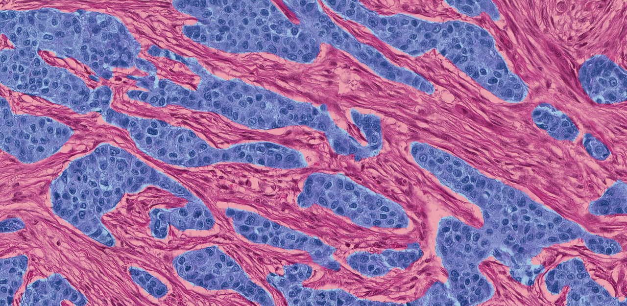 The Hypoxome of the Tumor Microenvironment 