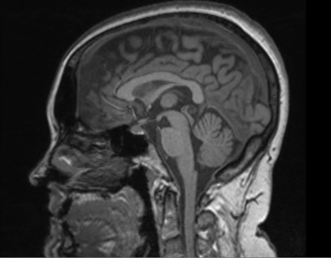 Q&A: Is space travel bad for the brain?