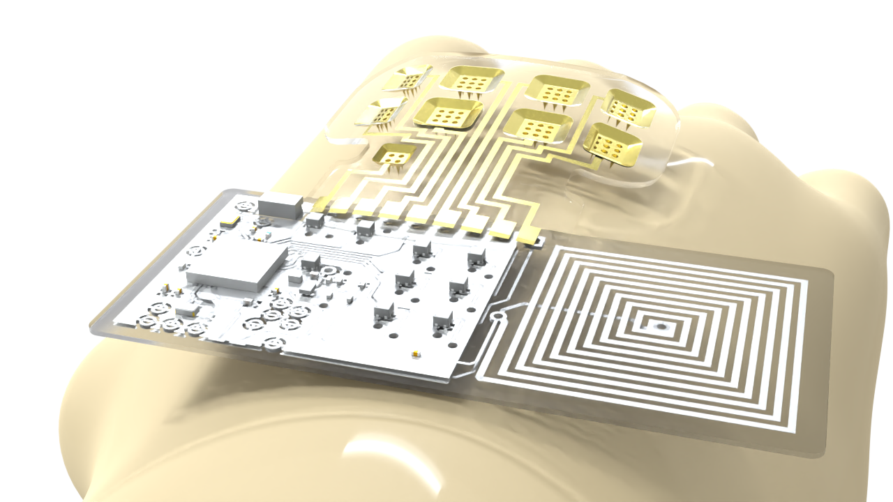 Next Generation Drug Delivery: The Spatiotemporal On-demand Patch (SOP )