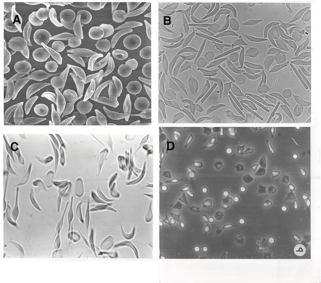A bloody tale - sickle cells in deer 