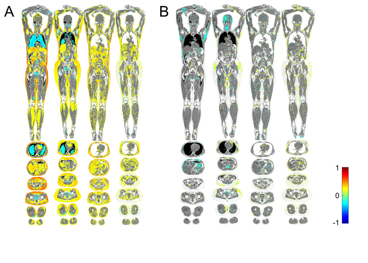 Metabolic profiling of galectin-1 and galectin-3: a cross-sectional, multi-omics, association study
