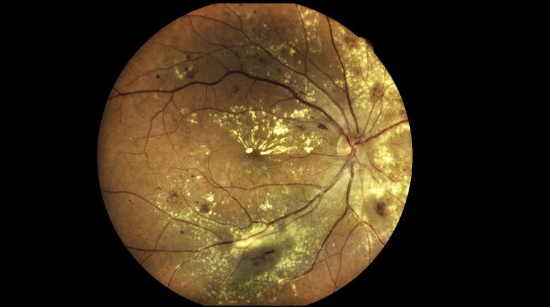 Macular degeneration Collection - Scientific Reports