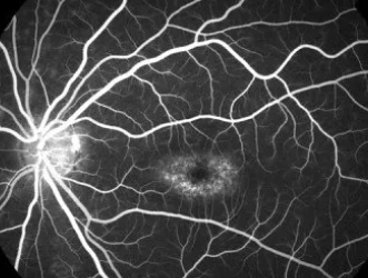 Listening to the unheard, youth voices in rare disease policy