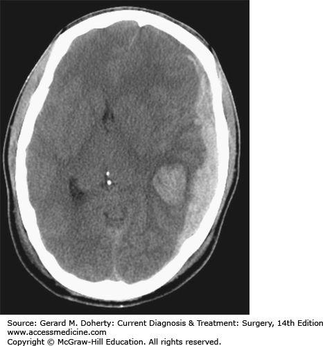 Subdural Hematoma