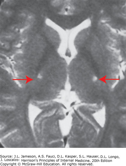 AccessMedicine's Image of the Week: Amyotrophic Lateral Sclerosis Findings on MRI