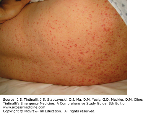 Image of the Week: Miliaria Rubra (Prickly Heat)