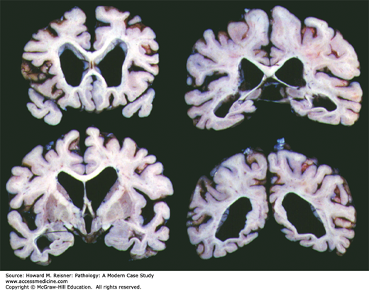 ​Alzheimer Disease Pathology