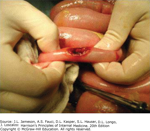 AccessMedicine's Image of the Week:  Ileal Perforation Associated with Salmonella Typhi Infection