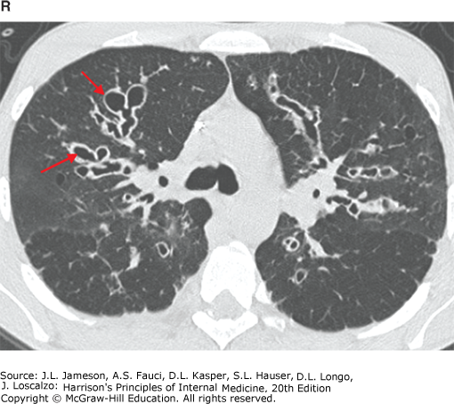 AccessMedicine's Image of the Week: CT Findings In Cystic Fibrosis