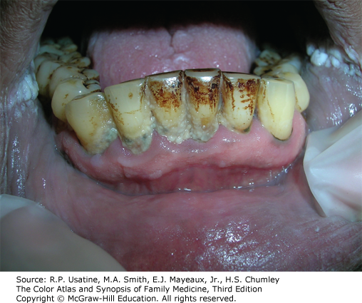 AccessMedicine's Image of the Week: Tobacco Stained Teeth and Periodontitis From Smoking Tobacco 