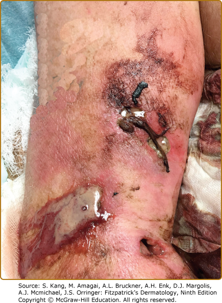 AccessMedicine's Image of the Week: Necrotizing Fasciitis Following Intravenous Drug Use