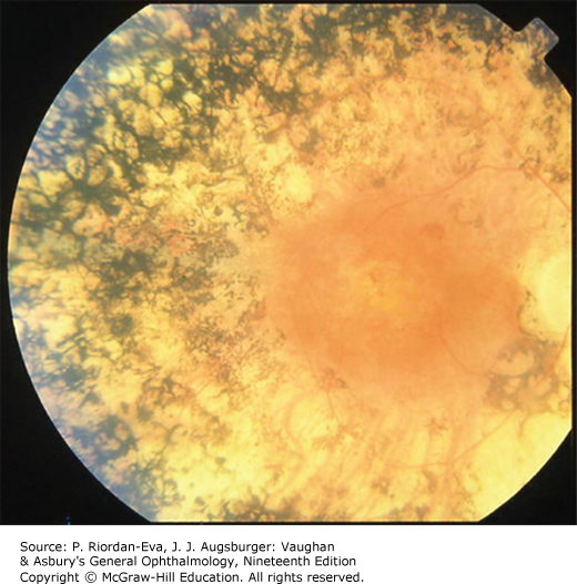 AccessMedicine's Image of the Week: Retinitis Pigmentosa 