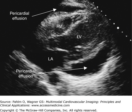 Pericardial Effusion on Transthoracic Echocardiogram
