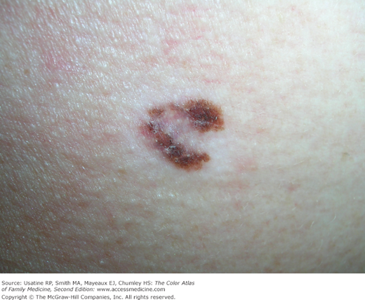 Image of the Week: Melanoma In Situ