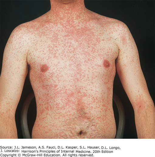 Access Medicine's Image of the Week: Measles