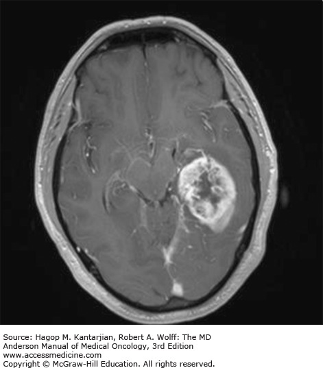 AccessMedicine's Image of the Week: Glioblastoma