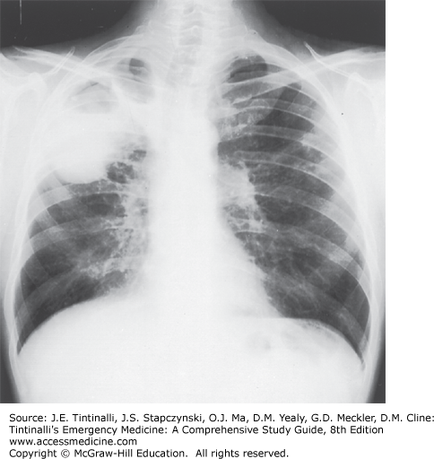 Cavitary Tuberculosis of the Right Upper Lobe on Chest Radiography