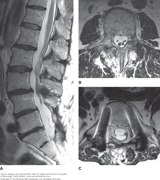 Lumbosacral MRI of a Patient With Lymphoma