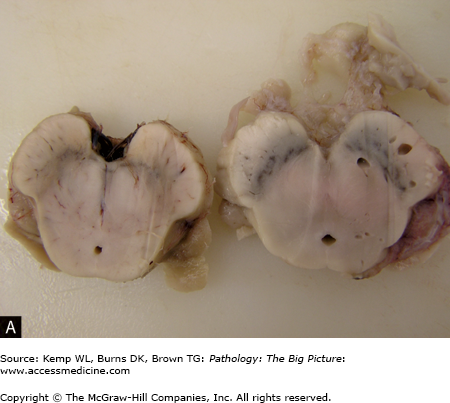 AccessMedicine's Image of the Week: Neuropathology of Parkinson Disease