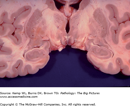 AccessMedicine's Image of the Week: Wernicke Encephalopathy