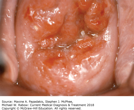 AccessMedicine's Image of the Week:  Cervical Intraepithelial Neoplasia (CIN)
