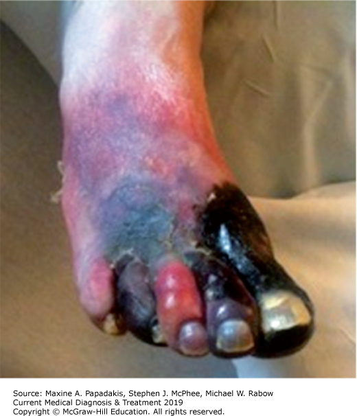 AccessMedicine's Image of the Week: Deep Frostbite