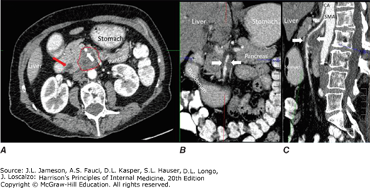 AccessMedicine's Image of the Week: CT Findings Associated with Pancreatic Cancer