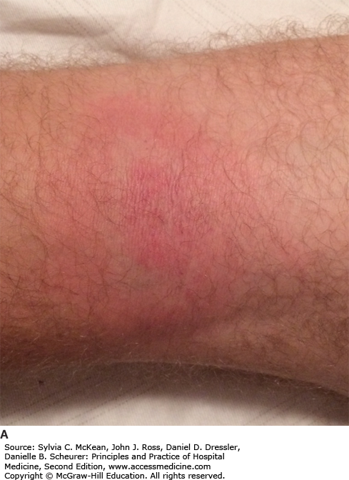 Image of the Week: Erythema Migrans