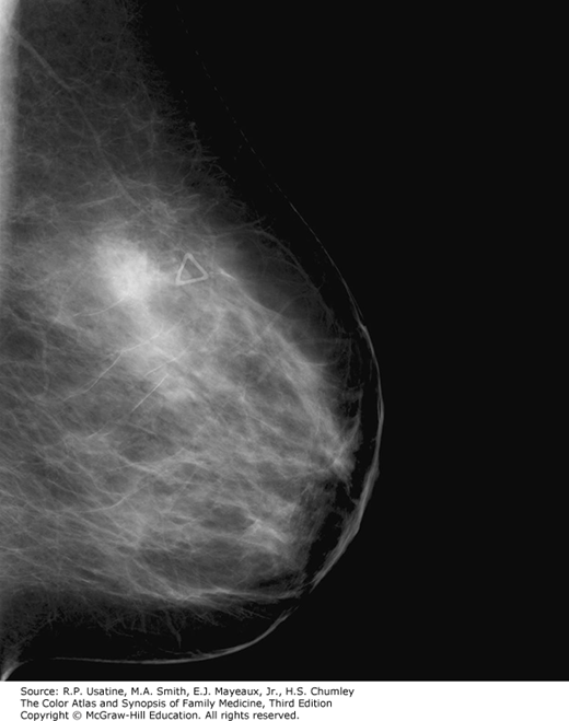 Breast Cancer on Mammogram | AccessMedicine Network