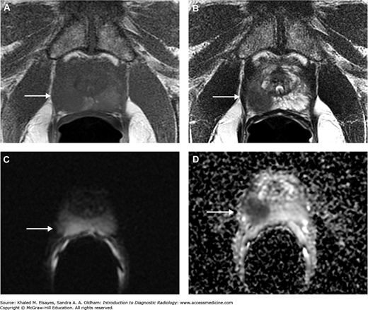 Prostate Cancer on MRI