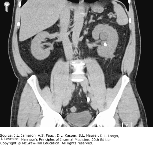 Renal Calculi on CT