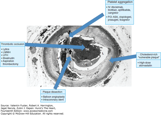Coronary Plaque Rupture