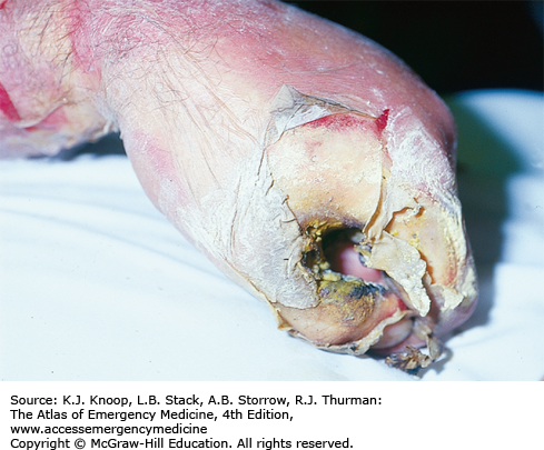 Electrical Burn Injury