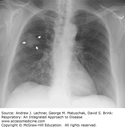 Non-Small Cell Lung Cancer