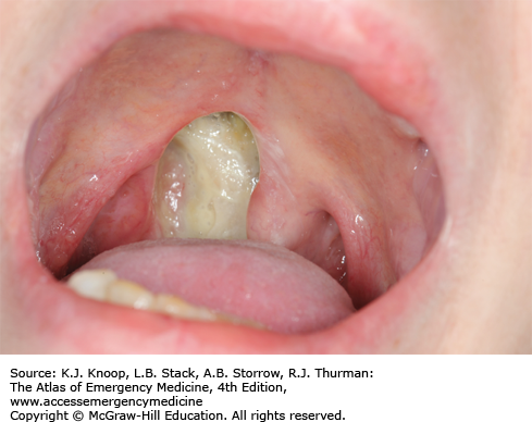 Opioid Mucosal Necrosis