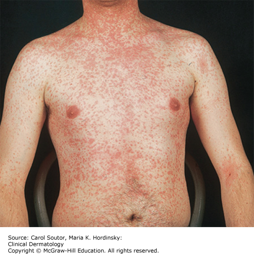 Measles (Rubeola)