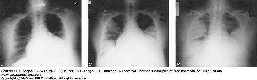 Legionnaires' Disease on Chest Radiograph